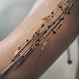 A close-up photograph of a person's forearm, showing acupuncture needles inserted into specific points known to help regulate blood sugar levels, highlighting the role of acupuncture in promoting overall health and wellness.